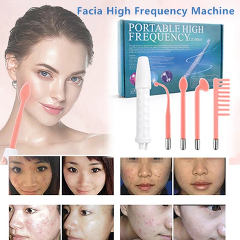 High Frequency Facial Wand for Skin Therapy & Acne Treatment - The Girly Things